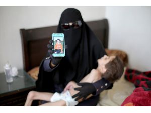 Syria girl struggles with illness in besieged E. Ghouta